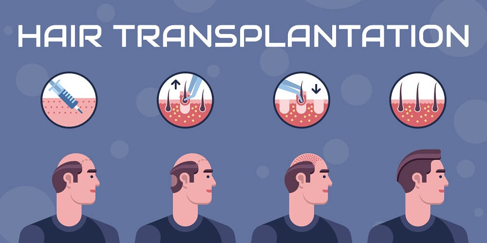 Hair Transplant Recovery | Hair Transplant Recovery Timeline