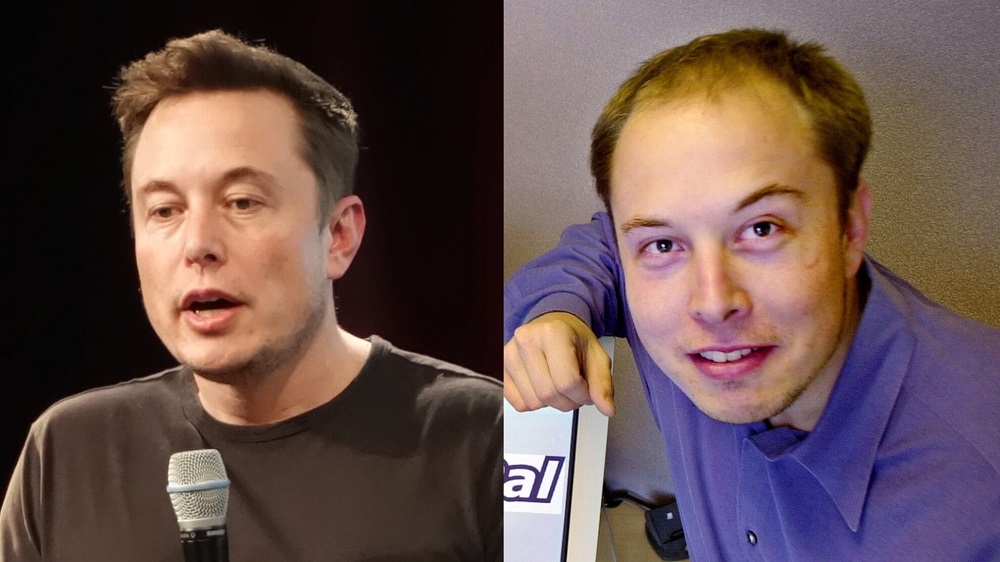 Elon Musk before and after hair transplant