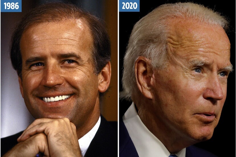 Joe Biden before and after hair transplant