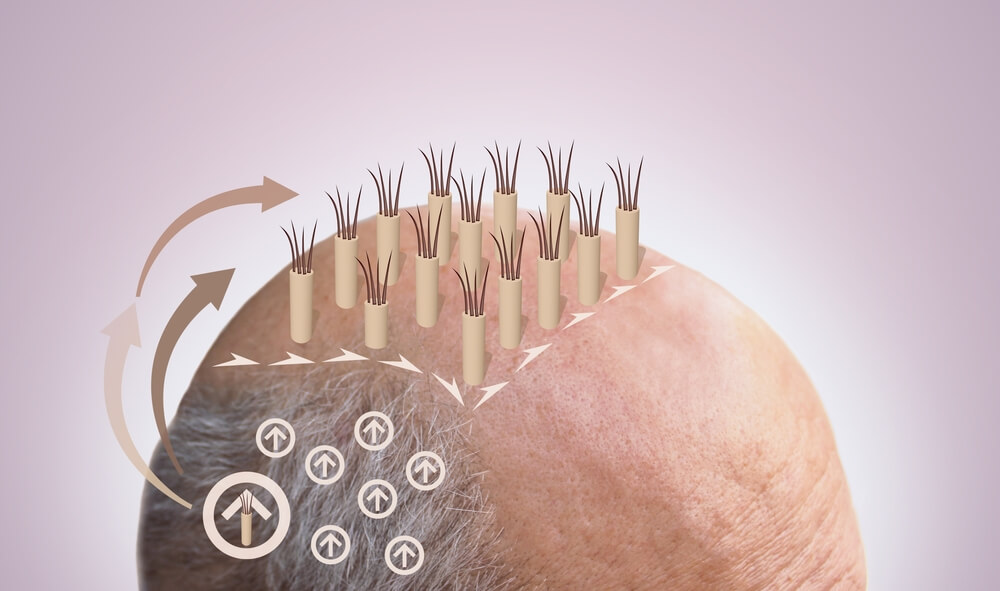 an illustration of hair plugs