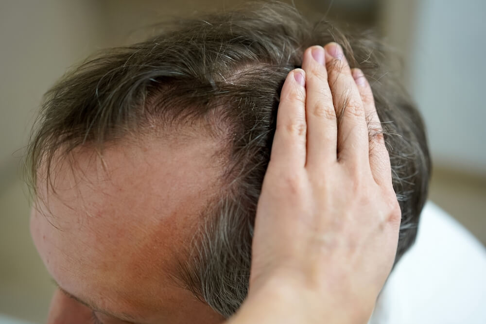 a balding scalp of a man